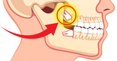 impacted wisdom teeth