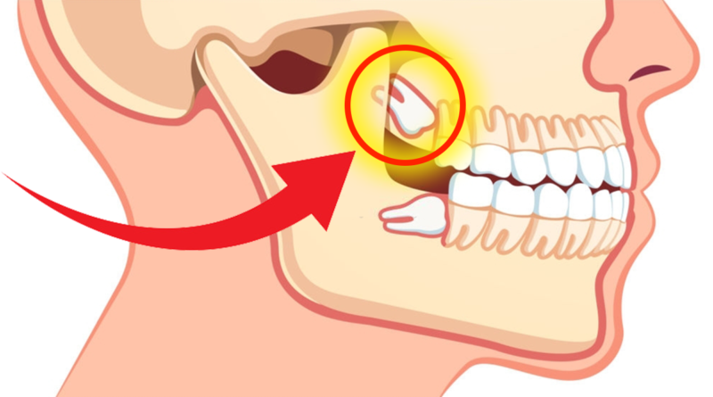 impacted wisdom teeth